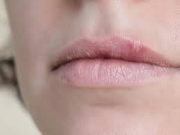 lippenherpes verlauf symptome