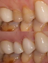 Before And After Pure Dental Care In Hillsborough Nj