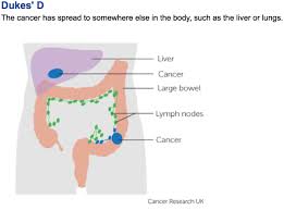 Colon Cancer Disease State Review With Sample Patient Case
