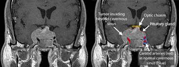 Image result for icd 10 code for pituitary microadenoma