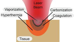 non ionizing laser radiation in