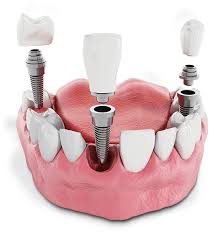 dental implant grants implant dental