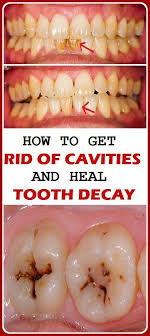 5 how to brush your teeth. How To Get Rid Of Cavities And Heal Tooth Decay Dental Decay Tooth Decay Oral Care