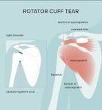 Image result for icd 10 code for right shoulder chronic rotator cuff tear