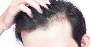 vitamin d deficiency hair loss