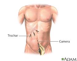 gallbladder removal laparoscopic