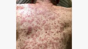 hiv rash what does it look like and