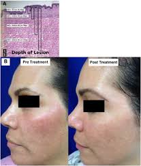 laser and light therapy in melasma