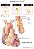 Image result for icd 10 code for acute non stemi