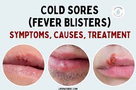fever blisters vs cold sores