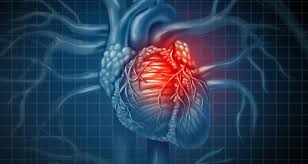 1 infarto agudo al miocardio dr. Cuarta Definicion De Infarto Agudo De Miocardio Consideraciones Anestesicas Perioperatorias
