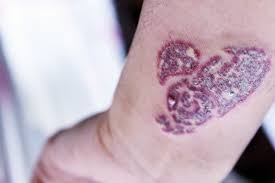 You may not think of acne as being a major medical condition—it isn't. Healthier You Tattoo You Medical Tattoos On The Rise