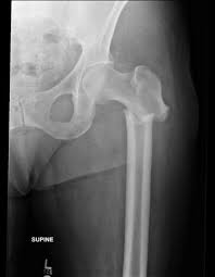 subtrochanteric fractures trauma