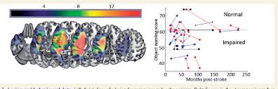 Figure 1 From Right Hemisphere Structural Adaptation And