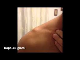 Maybe you would like to learn more about one of these? Lussazione Ac Acromion Claveare Di Terzo Grado Youtube