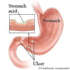 peptic ulcer disease care instructions