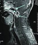 Image result for craniocervical syndrome
