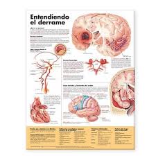 Understanding Stroke Anatomical Chart In Spanish