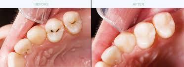 Cavity fill cost without insurance cavity filling costs solely depend on the type of filling, the dentist, the location, and the number of teeth. Dental Fillings By Dr Whitney Sebree Surprise Arizona