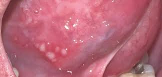 what are herpetiform canker sores