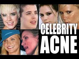 celebrities with acne you
