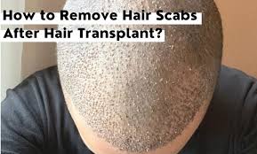 scabs after hair transplant when and