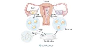 Fertility treatment: In vitro fertilization (IVF) | BabyCenter