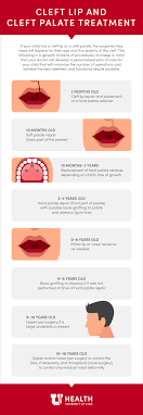 cleft lip and cleft palate treatment