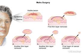 However, in the case of a malignant melanoma, it really depends on the stage. Skin Cancer Treatment Pdq Patient Version National Cancer Institute