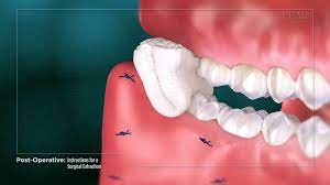 How long after a tooth extraction should i be seeing signs of blood on guaze.extraction was tues and been i'm wondering how long do you keep the gauze in for after a tooth extraction? Instructions After Tooth Removal Tooth Extraction Care Instructions