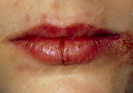 ed lips of affected by herpes