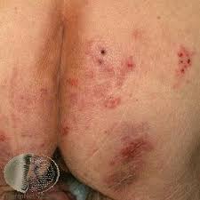 dermais herpetiformis or gluten rash