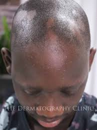 alopecia in men alopecia camouflage