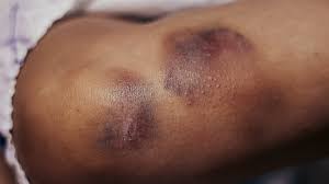 leukemia rashes and bruises symptoms