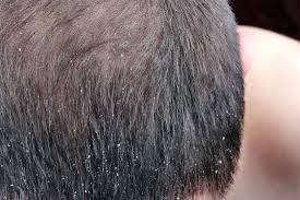 We did not find results for: Lice Vs Dandruff Differences Pictures And Symptoms