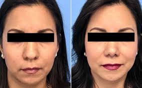 the guide to bulbous nose rhinoplasty