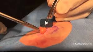 lipoma excision chest with dr timothy
