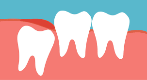 wisdom teeth molar extraction
