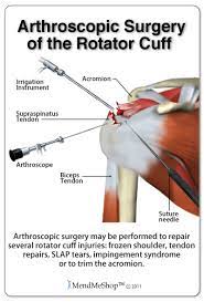 shoulder post surgery rehabilitation