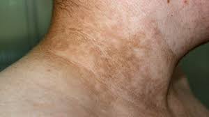 acanthosis nigricans treatment