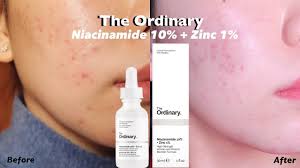 What's new in store explore what's hot in your store. The Ordinary Niacinamide 10 Zinc 1 Before After Youtube