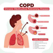 Of copd, among other benefits. Free Vector Hand Drawn Chronic Obstructive Pulmonary Disease Infographic