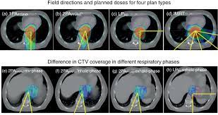 esophageal cancer