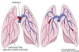 Plicní embolie je život ohrožující onemocnění cévního systému, při němž dochází ke snížení průtoku krve plicním řečištěm. Plicni Embolie Medicina Nemoci Studium Na 1 Lf Uk