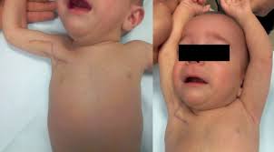 According to reports in the medical literature, poland syndrome appears to be three times as plastic surgery may be performed to rebuild the chest wall and to graft ribs into their proper places. Pterygium Axillae As A Rare Manifestation Of Poland Syndrome Sciencedirect