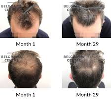 minoxidil proven for hair loss