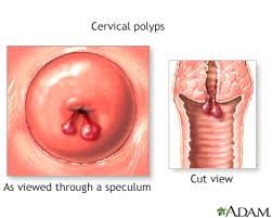 cervical polyps information mount