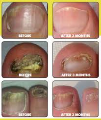 laser treatment for fungal nail disease