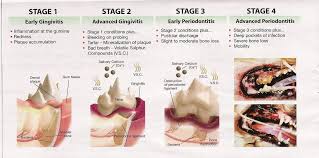 Stages Of Periodontal Disease Tooth Infection Dental