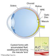 macular edema information symptoms